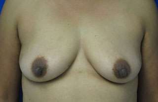 Breast Augmentation Revision Before & After Patient #7648