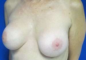 Breast Augmentation Revision Before & After Patient #7657
