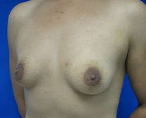 Breast Augmentation Revision Before & After Patient #7660