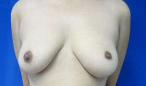 Breast Augmentation Revision Before & After Patient #7663