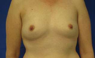 Breast Augmentation Revision Before & After Patient #7666