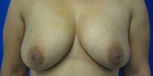 Breast Augmentation Revision Before & After Patient #7669