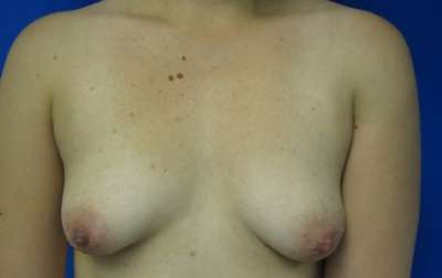 Breast Augmentation Revision Before & After Patient #7672