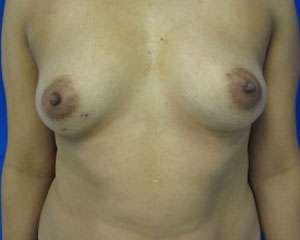 Breast Augmentation Revision Before & After Patient #7675