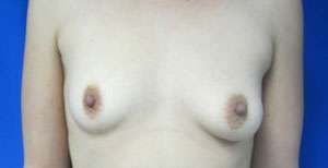 Breast Augmentation Revision Before & After Patient #7678