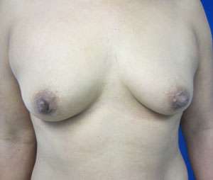 Breast Augmentation Revision Before & After Patient #7684