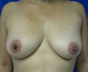 Breast Augmentation Revision Before & After Patient #7687