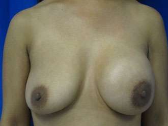 Breast Augmentation Revision Before & After Patient #7690