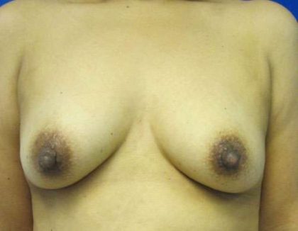 Breast Augmentation Revision Before & After Patient #7696