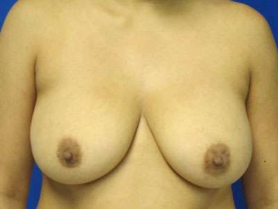 Breast Augmentation Revision Before & After Patient #7699