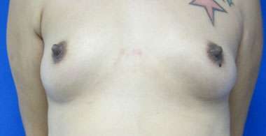 Breast Augmentation Revision Before & After Patient #7708