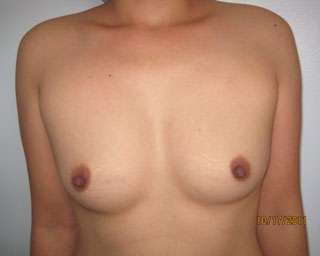 Breast Augmentation Revision Before & After Patient #7711