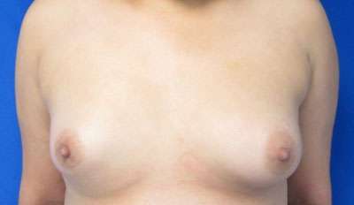 Breast Augmentation Revision Before & After Patient #7717