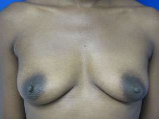 Breast Augmentation Revision Before & After Patient #7723