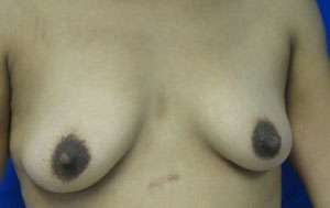 Breast Augmentation Revision Before & After Patient #7729