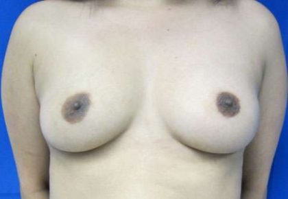 Breast Augmentation Revision Before & After Patient #7738