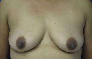 Breast Augmentation Revision Before & After Patient #7741
