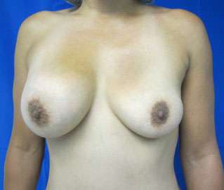 Breast Augmentation Revision Before & After Patient #7744