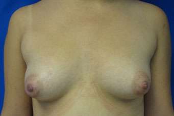 Breast Augmentation Revision Before & After Patient #7750