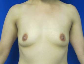 Breast Augmentation Revision Before & After Patient #7753