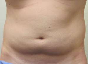 Bodytite Before & After Patient #6060