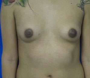 Breast Augmentation Revision Before & After Patient #7762