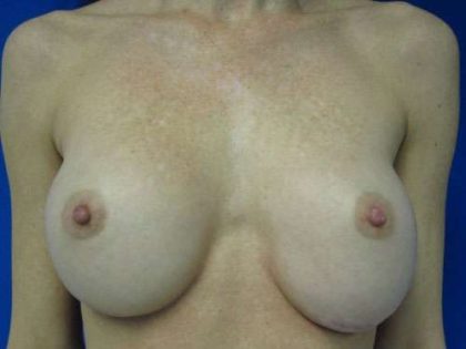 Breast Augmentation Revision Before & After Patient #7768