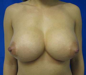 Breast Augmentation Revision Before & After Patient #7780