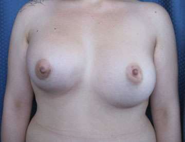 Breast Augmentation Revision Before & After Patient #7783