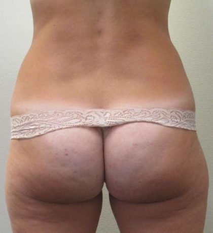 Bodytite Before & After Patient #6063