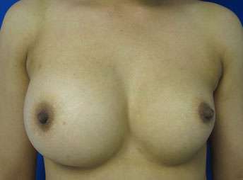 Breast Augmentation Revision Before & After Patient #7789