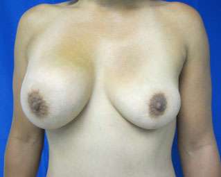 Breast Augmentation Revision Before & After Patient #7795