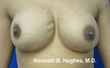 Breast Augmentation with Fat Grafting Before & After Patient #7798