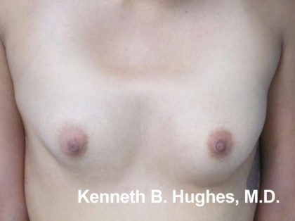 Breast Augmentation with Fat Grafting Before & After Patient #7801