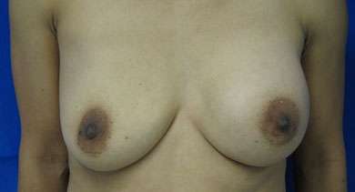 Breast Augmentation with Fat Grafting Before & After Patient #7810