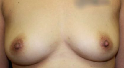 Breast Augmentation with Fat Grafting Before & After Patient #7813