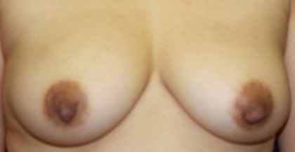 Breast Augmentation with Fat Grafting Before & After Patient #7816