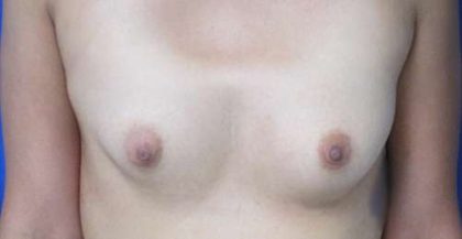 Breast Augmentation with Fat Grafting Before & After Patient #7819