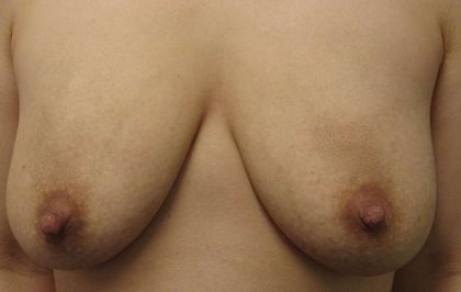 Breast Lift Before & After Patient #7836