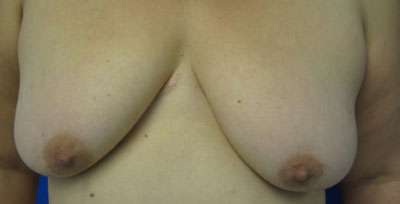 Breast Lift Before & After Patient #7839