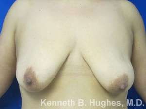 Breast Lift Before & After Patient #7842