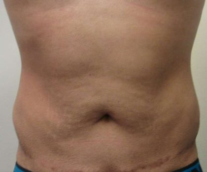 Bodytite Before & After Patient #6069