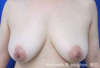 Breast Lift Before & After Patient #7857