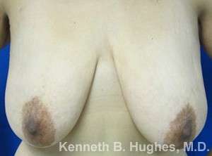 Breast Lift Before & After Patient #7860