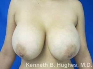 Breast Lift Before & After Patient #7863