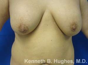 Breast Lift Before & After Patient #7872