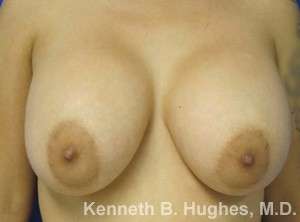 Breast Lift Before & After Patient #7881
