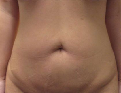 Bodytite Before & After Patient #6072