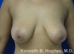 Breast Lift Before & After Patient #7884