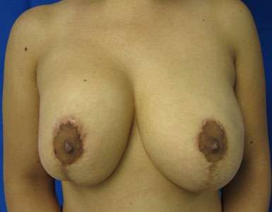 Breast Lift Before & After Patient #7887